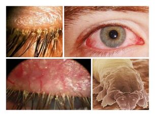 Sintomi della presenza di parassiti sotto la pelle umana